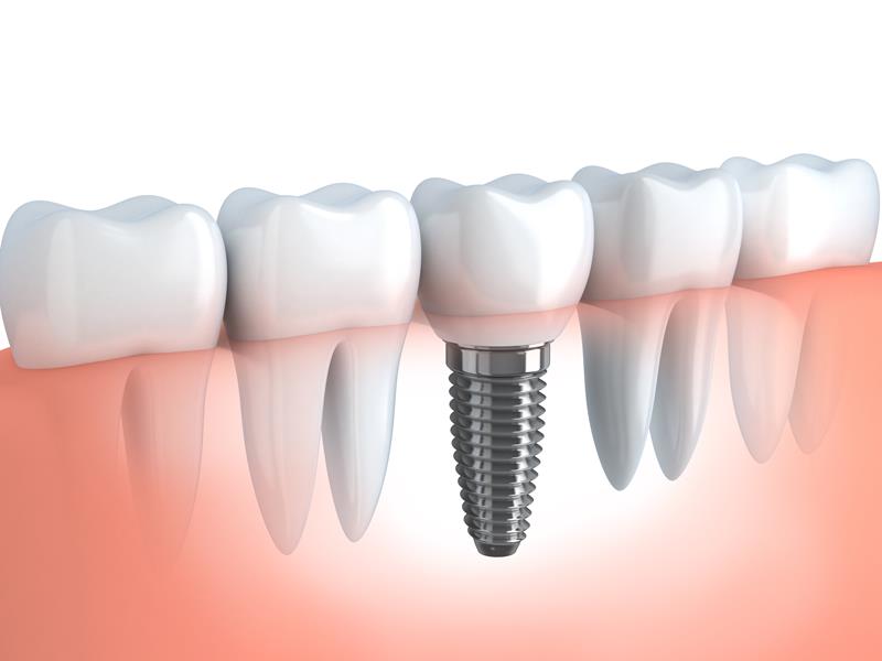 Dental Implants Philadelphia, PA